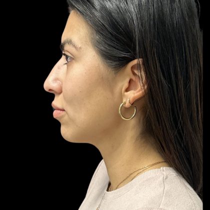 Cheek Filler Before & After Patient #10724