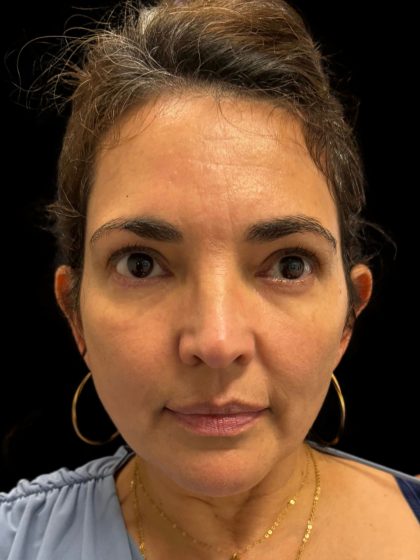 Morpheus8 Before & After Patient #10719