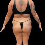 Brazilian Butt Lift Before & After Patient #10722