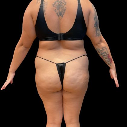 Brazilian Butt Lift Before & After Patient #10722