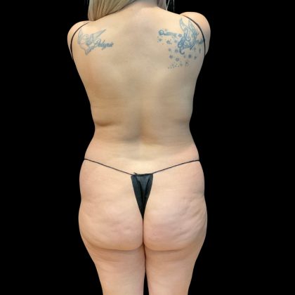 Brazilian Butt Lift Before & After Patient #10718