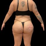 Brazilian Butt Lift Before & After Patient #10722