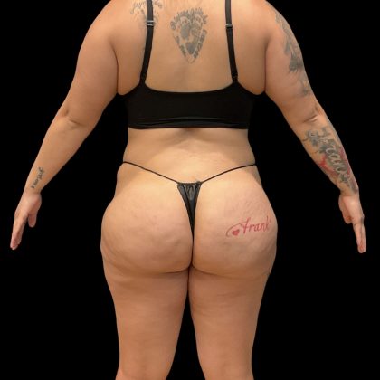 Brazilian Butt Lift Before & After Patient #10722