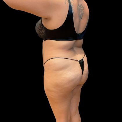 Brazilian Butt Lift Before & After Patient #10722