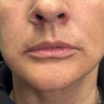Lip Filler Before & After Patient #10723