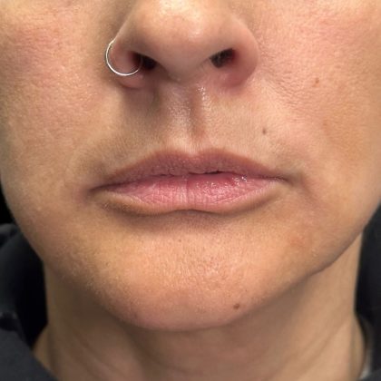 Lip Filler Before & After Patient #10723