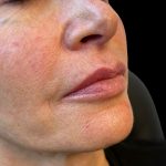 Lip Filler Before & After Patient #10725