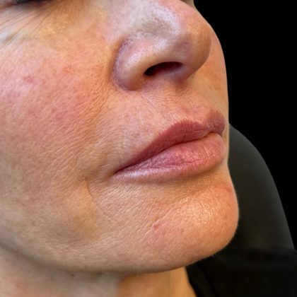 Lip Filler Before & After Patient #10725