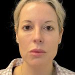 Morpheus8 Before & After Patient #10720