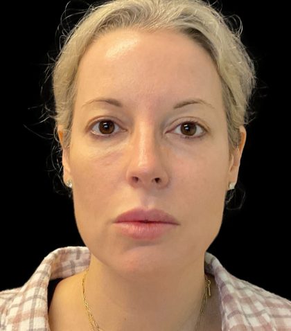 Morpheus8 Before & After Patient #10720