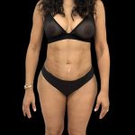 Brazilian Butt Lift Before & After Patient #10807