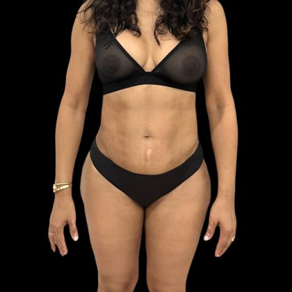 Brazilian Butt Lift Before & After Patient #10807