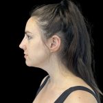 Liquid Rhinoplasty Before & After Patient #10809