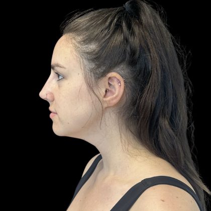 Liquid Rhinoplasty Before & After Patient #10809