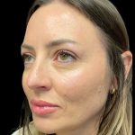 Sculptra Before & After Patient #10808