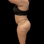 Brazilian Butt Lift Before & After Patient #10722