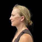 Facelift Before & After Patient #10717