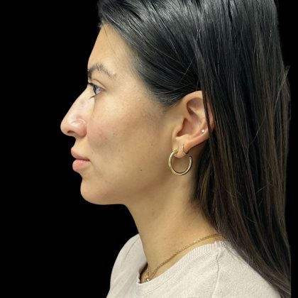 Cheek Filler Before & After Patient #10724