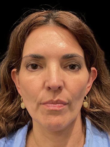 Morpheus8 Before & After Patient #10719