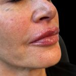 Lip Filler Before & After Patient #10725