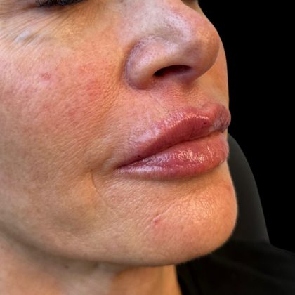 Lip Filler Before & After Patient #10725