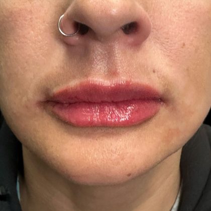 Lip Filler Before & After Patient #10723