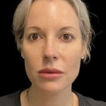 Morpheus8 Before & After Patient #10720
