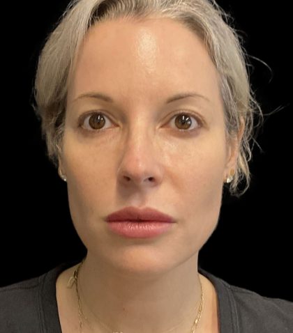 Morpheus8 Before & After Patient #10720