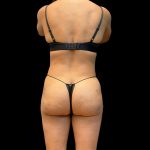 Brazilian Butt Lift Before & After Patient #10807