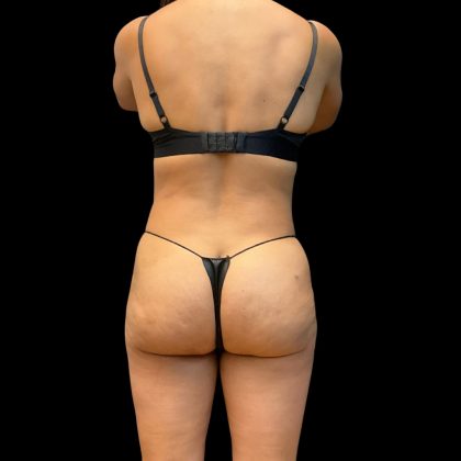 High Definition Liposuction Before & After Patient #10806
