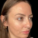 Sculptra Before & After Patient #10808