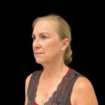 Facelift Before & After Patient #10717