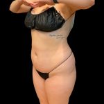 Brazilian Butt Lift Before & After Patient #10718