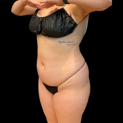 Brazilian Butt Lift Before & After Patient #10718