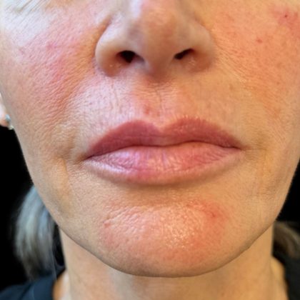 Lip Filler Before & After Patient #10725
