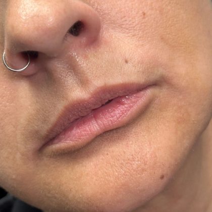 Lip Filler Before & After Patient #10723