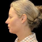 Morpheus8 Before & After Patient #10720
