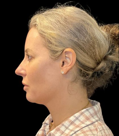 Morpheus8 Before & After Patient #10720