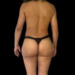 Brazilian Butt Lift Before & After Patient #10807