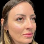 Sculptra Before & After Patient #10808