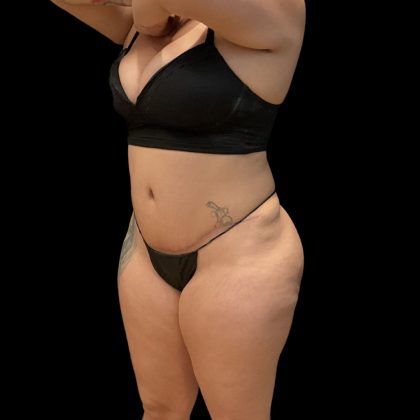 Brazilian Butt Lift Before & After Patient #10722