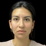 Cheek Filler Before & After Patient #10724