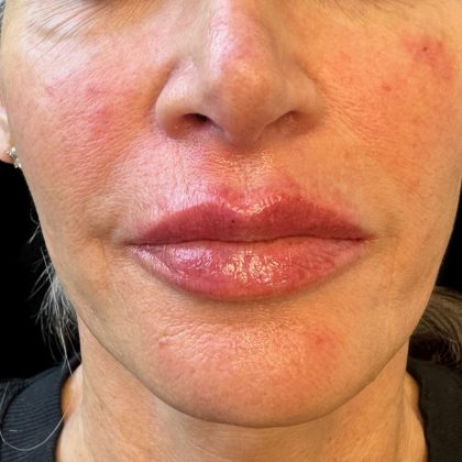 Lip Filler Before & After Patient #10725