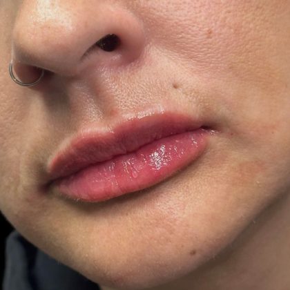 Lip Filler Before & After Patient #10723