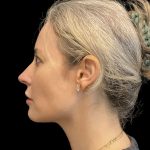 Morpheus8 Before & After Patient #10720