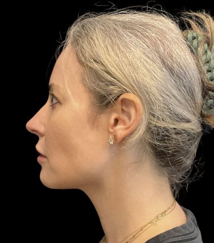 Morpheus8 Before & After Patient #10720