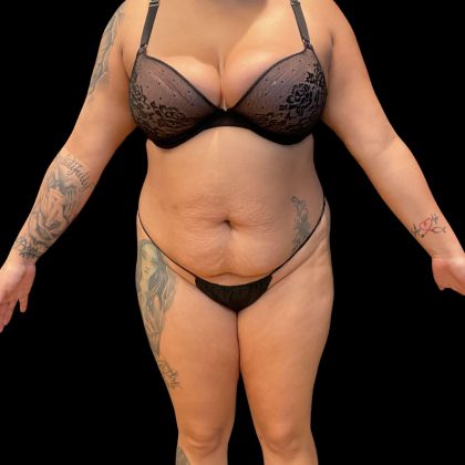 Brazilian Butt Lift Before & After Patient #10722