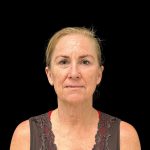 Facelift Before & After Patient #10717