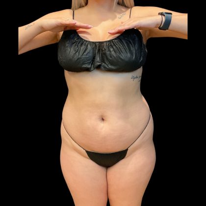 Brazilian Butt Lift Before & After Patient #10718