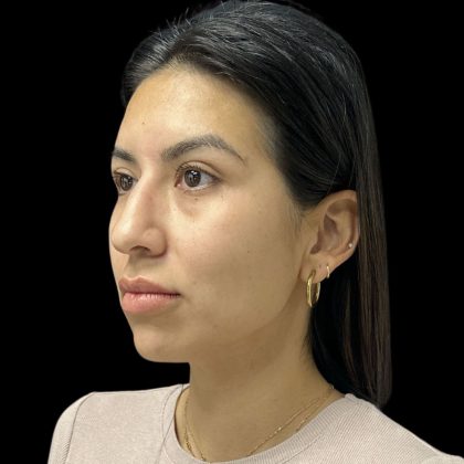 Cheek Filler Before & After Patient #10724